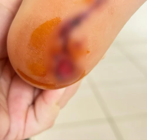 Após ataque de piranha em praia de Palmas, criança fica ferida e mãe denuncia abandono: ‘Ninguém para ajudar'