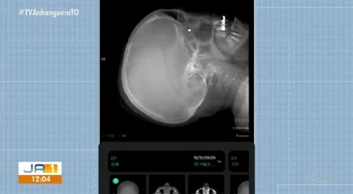 Mulher fica com chumbinho alojado no olho após acidente em barraca de tiro irregular