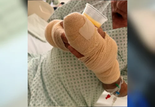 Idoso de 83 anos atacado por pitbull em Palmas passa por quarta cirurgia em dez dias