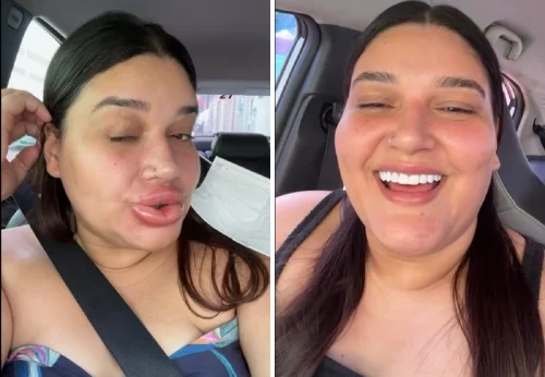 Maquiadora viraliza com lábios inchados após aplicação de enzima para remover preenchimento